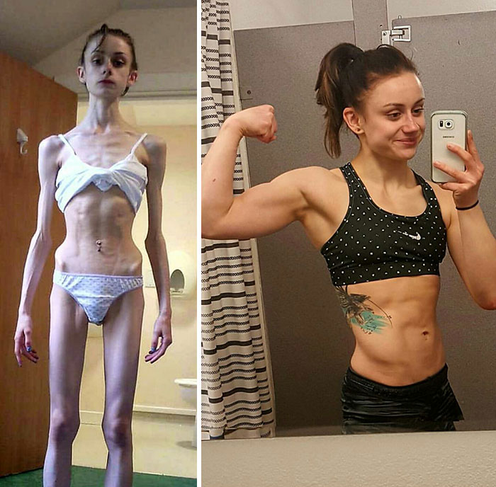 Antes y depués de la anorexia