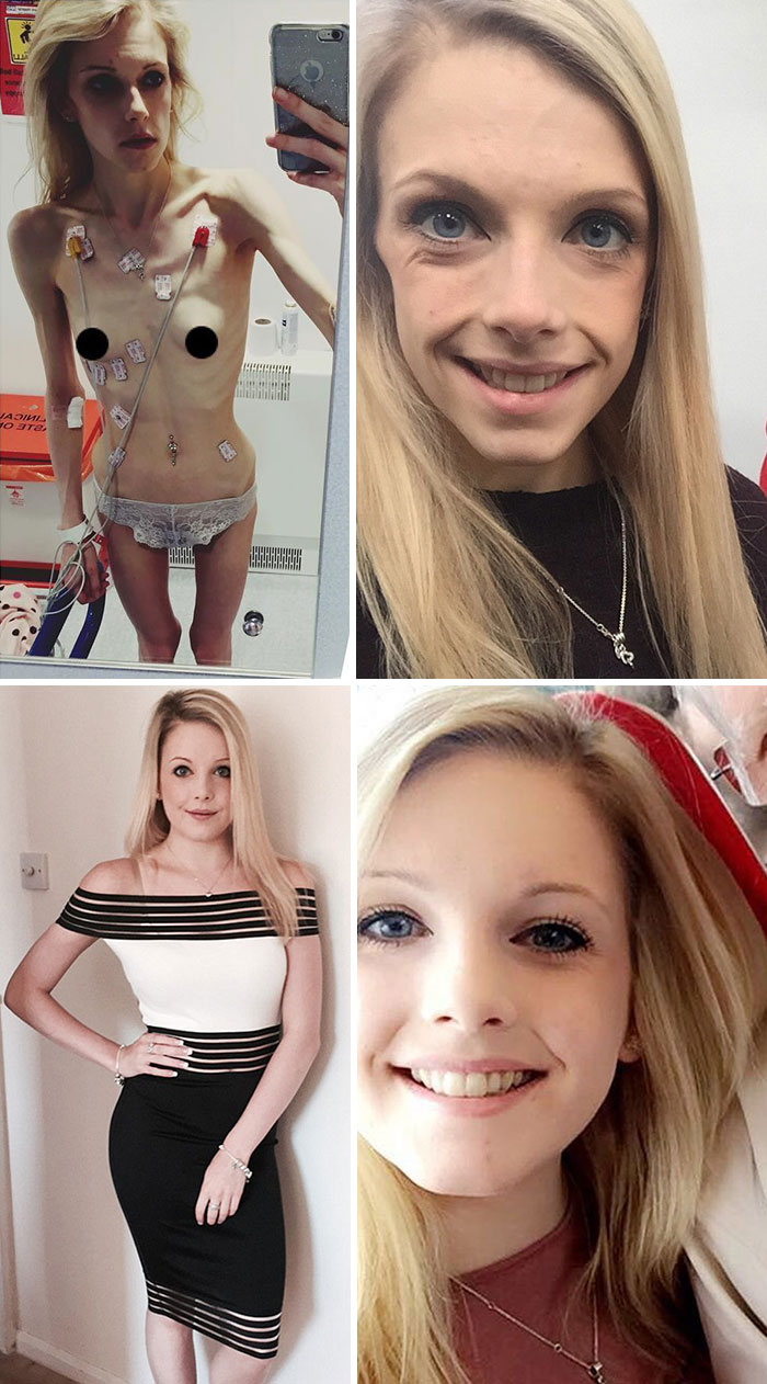 120 Before After Pics Of People Who Defeated Anorexia Bored Panda