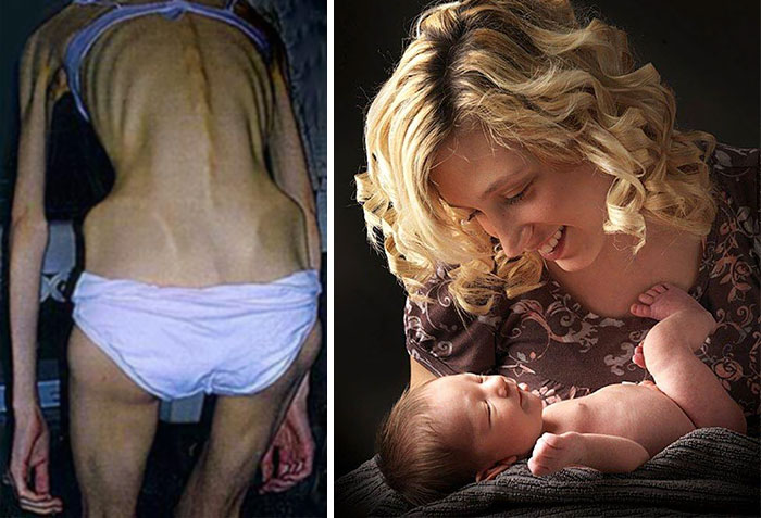Hayley Wilde sufría una anorexia tal que no le daban más de 10 días de vida, pero siguió adelante y llegó a tener un hijo