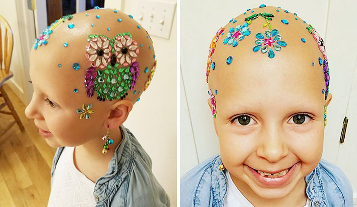 This 7-Year-Old Girl Didn’t Let Alopecia Stop Her From Dazzling Everyone At School On Crazy Hair Day