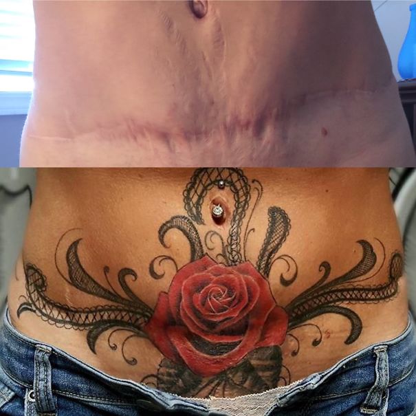 Tummy Tuck Scar Coverup Tattoo