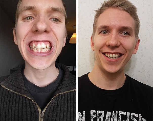 After Almost Two Years, I Just Got My Braces Off