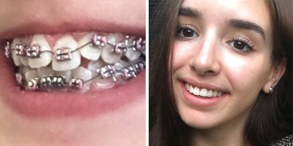 13 Months Of Braces, A Mechanical Bite Expansion And Two Veneers Later