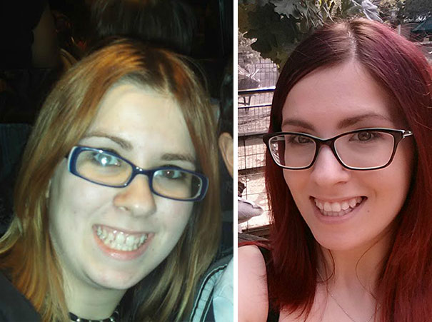 Before And After Braces, New Hair And Glasses Too