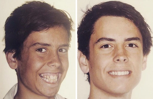 2 Years And 10 Months Of Braces