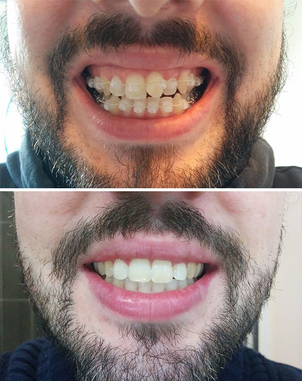 Here I Am Finished After Six Months In Braces. Four Days After Removal And I'm Still In Complete Shock