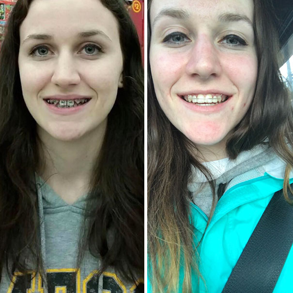 I Just Got My Braces Off! It's Been Two Years And Two Fake Teeth And Totally Worth It