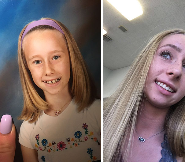 Shoutout To Braces For This Transformation