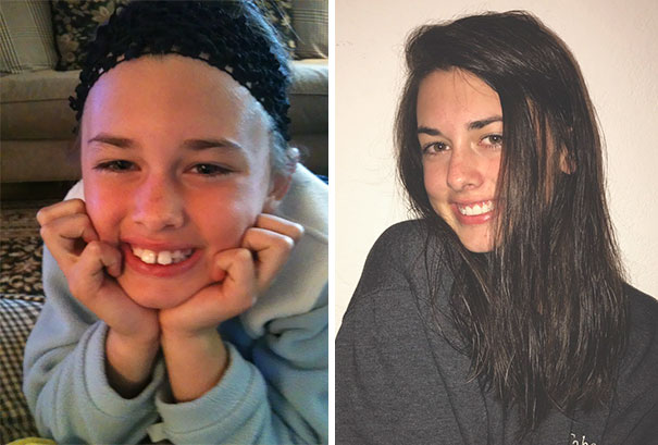 Since I Got My Braces Off Today, Here's A Little Transformation