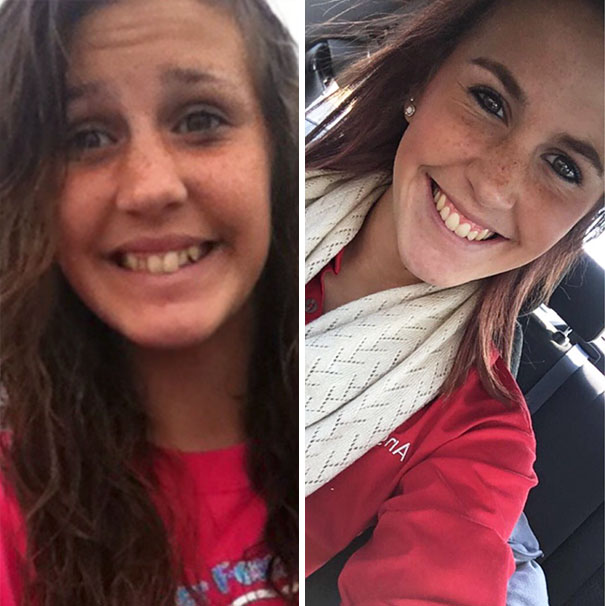 A Transformation Because Finally After Over 2 And A Half Years My Braces Are Off