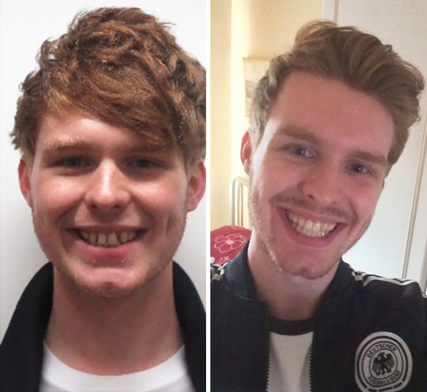 Finally Had My Braces Off! What A Massive Change 16 Months Has Made