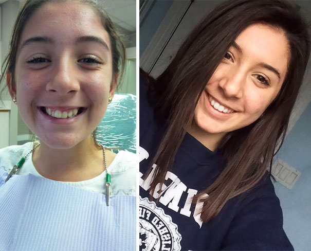 Before Braces And After Braces. 2 1/2 Years Difference. Thank God For Braces