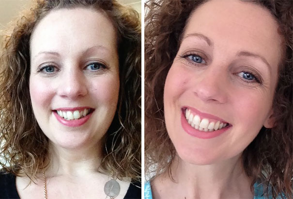 Smile Transformation - The Braces Are Off!