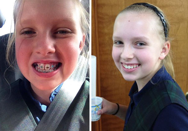 Lily Got Her Braces Off Today! What A Difference 1 Year Makes