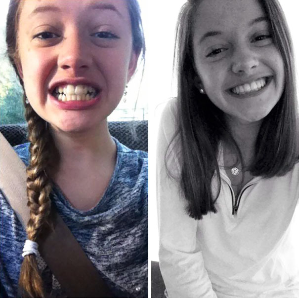 Oh What A Difference Braces And 2 Years Can Make