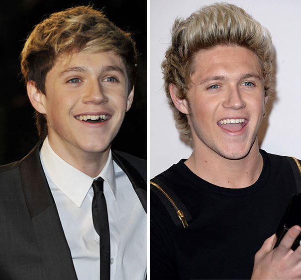 Niall Horan Before And After Braces