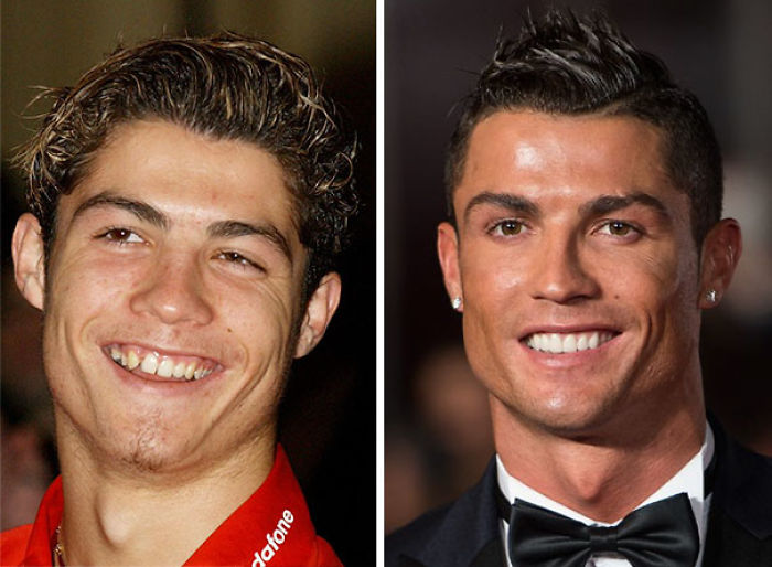 Cristiano Ronaldo antes y después de llevar aparato