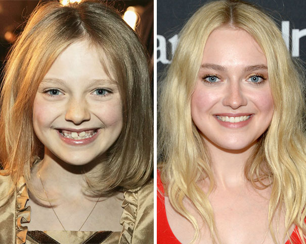 Dakota Fanning Before And After Having Braces
