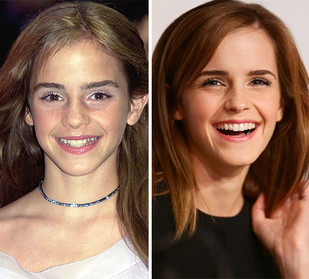 Emma Watson's Smile Transformation
