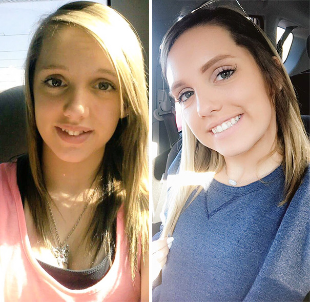 I Just Want To Thank Braces