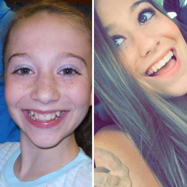 I Just Need To Take A Second And Thank My Orthodontist For Giving Me Braces