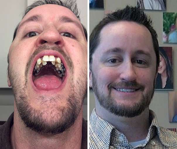 Progress Pics Of My Journey From Surgery To Braces To Straight Teeth