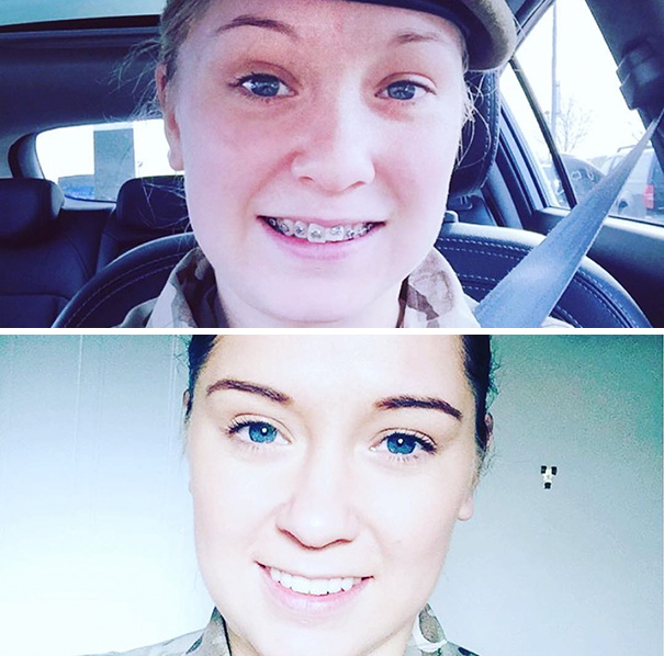 Looking Back To The First Day I Got Braces Then To The First Day They Came Off! 20 Months Of Cut Gums And Sore Teeth Was Well Worth It
