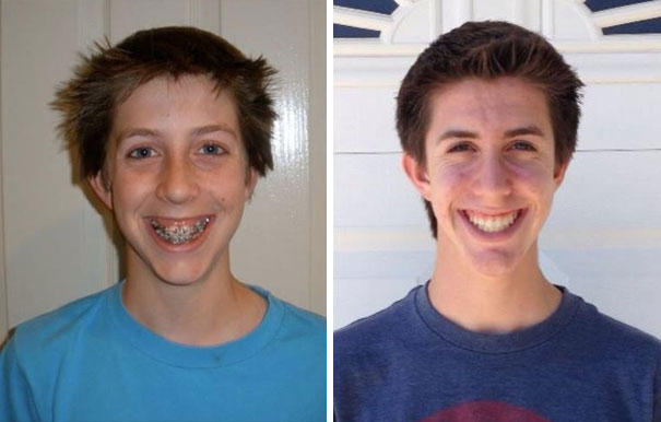 Before And After Braces. 4 Years Is A Long Time