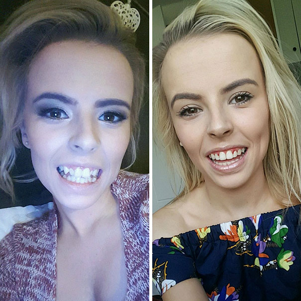 So Happy With How My Teeth Look Now