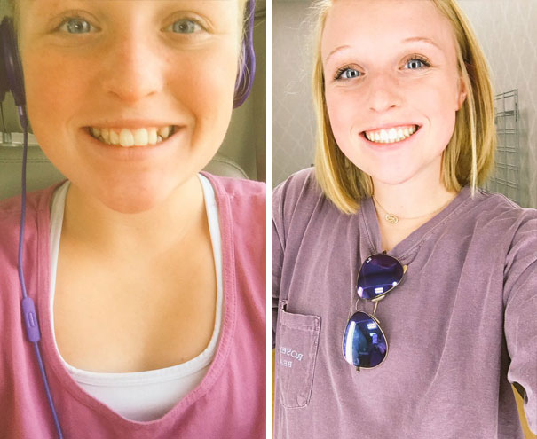Before And After Braces