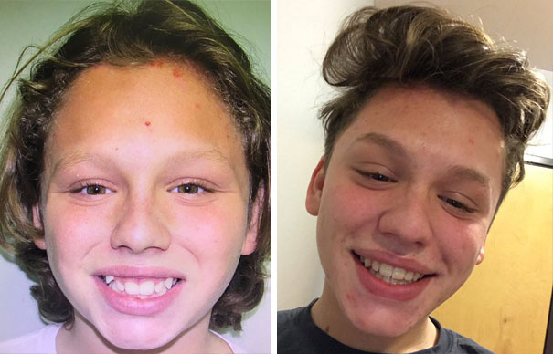 Before And After Braces