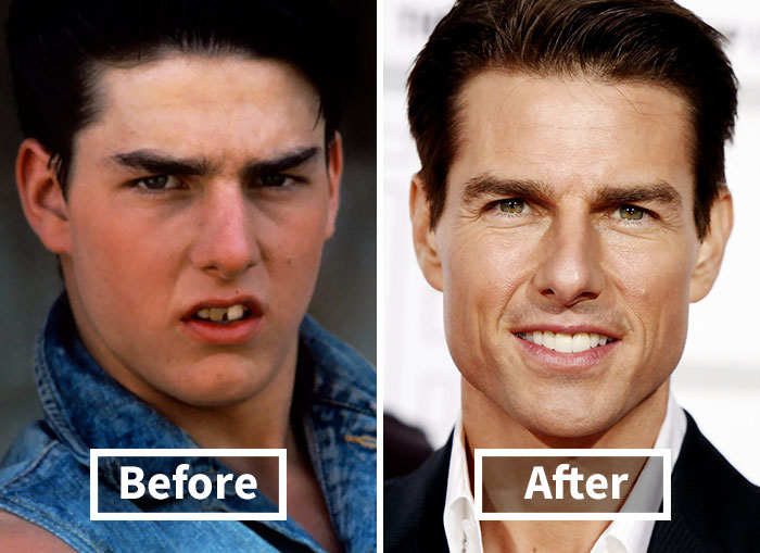114 Incredible Before & After Transformations Of People Who Wore Braces