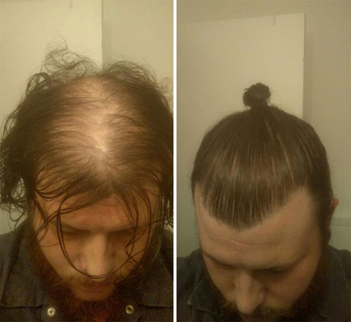 Man Bun tutupi kebotakan