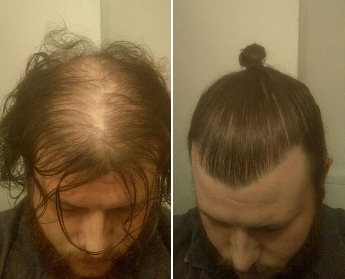 Men Are Hiding Baldness With Man Buns, But It’s Riskier Than You Think
