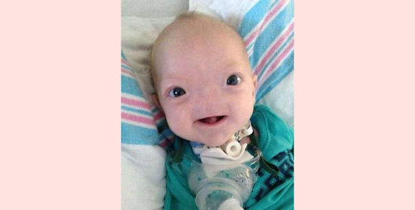 &lsquo;Miracle Baby&rsquo; Born Without A Nose Dies At Age Two