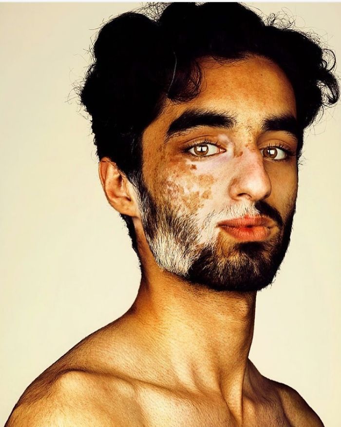 Photographer Brock Elbankcaptar Beauty In People With Vitiligo