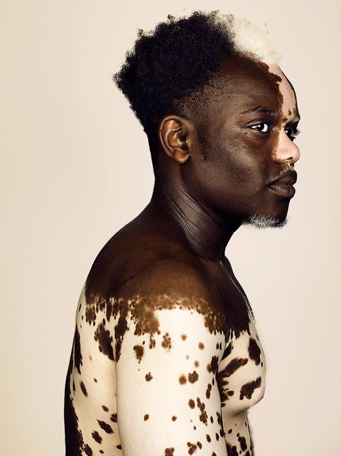 Photographer Brock Elbankcaptar Beauty In People With Vitiligo
