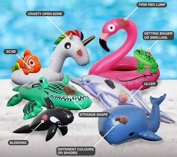 Skin Cancer On Inflatables: 8 Of The Most Common Symptoms Of Skin Cancer