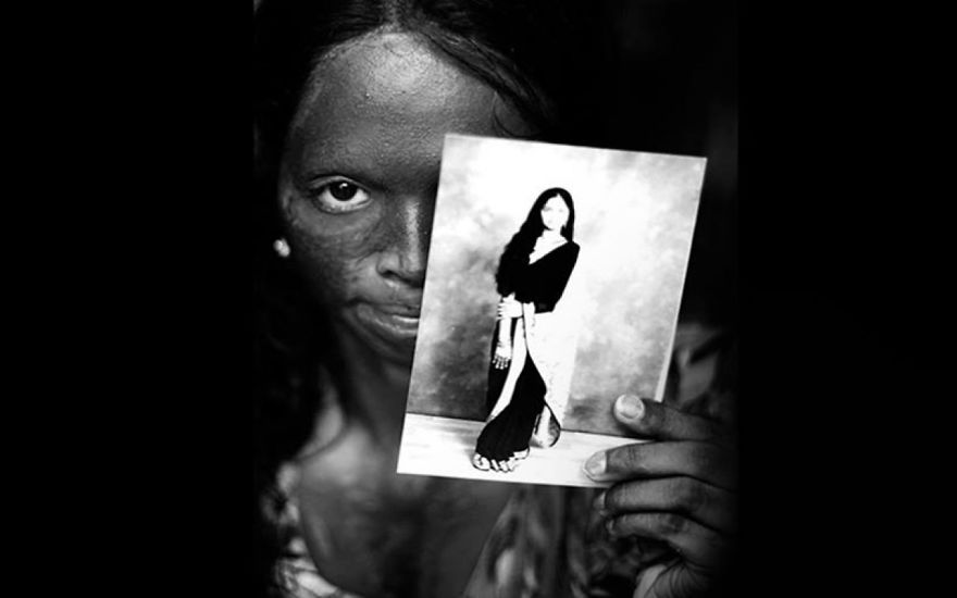 A Support Centre For Acid Attack Fighters