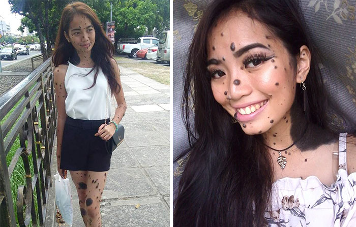 Woman Who Was Called A Monster For Her Head-To-Toe Hairy Moles Might Be The Next Miss Universe