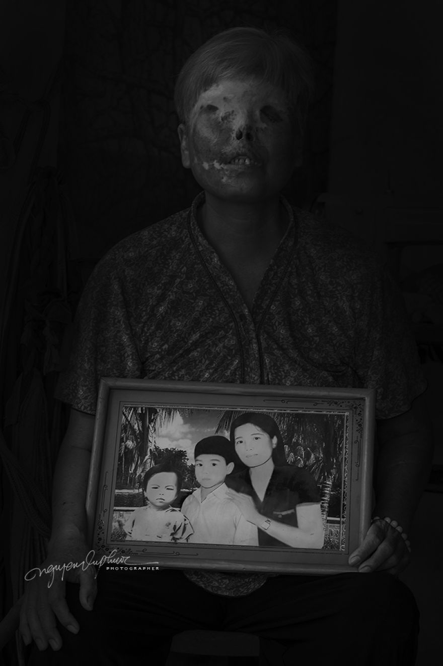 More Brutal Than Death Reality Of Acid Burn Victims Of Vietnam