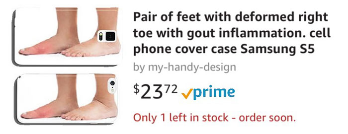 Pair Of Feet With Deformed Right Toe With Gout Inflammation Cell Phone Cover Case Samsung S5