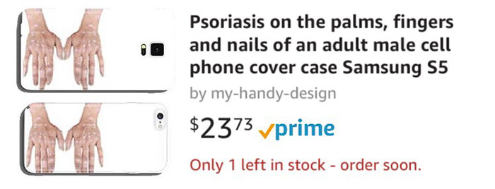 Psoriasis On The Palms, Fingers And Nails Of An Adult Male Cell Phone Cover Case Samsung S5