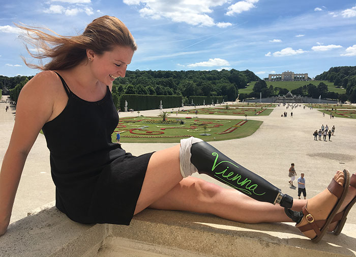 Girl Gets Herself A Chalkboard Leg For A Trip To Europe, And The World Falls In Love With Her