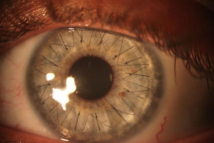Just In Case You've Ever Wondered What An Eyeball Looks Like After Having A Cornea Transplant