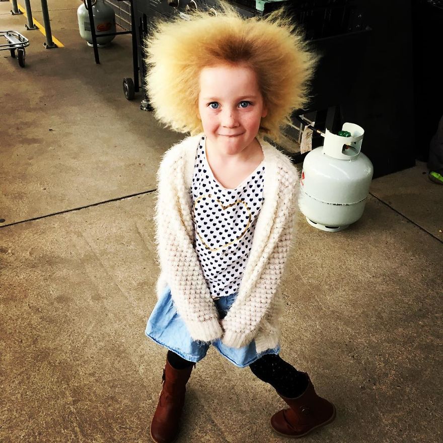 Meet The Rare Syndrome That Leaves The Girl's Hair Totally Wild, Literally Unthinkable