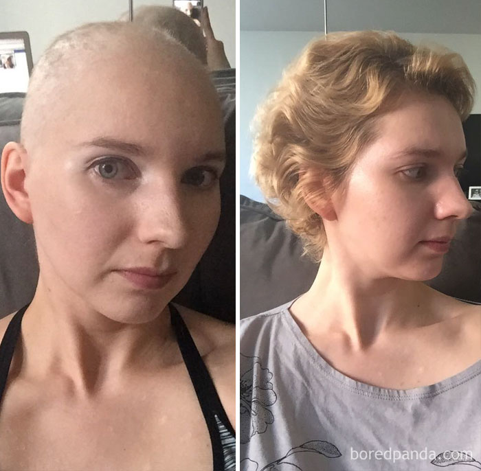 30 Incredible Before & After Pics Of People Who Beat Cancer That Will Make  You Appreciate Life | Bored Panda