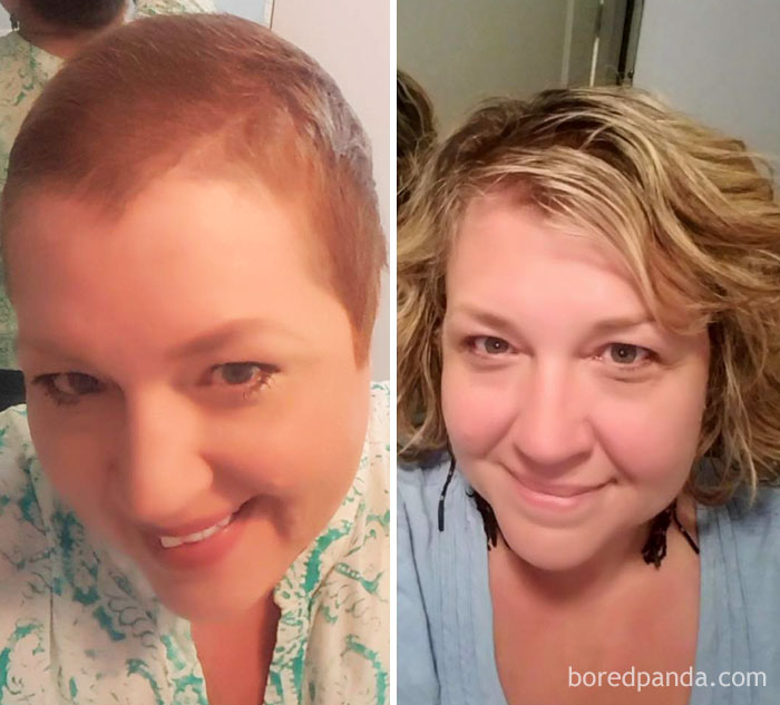 One Year Hair Growth. 15 Months Cancer-Free