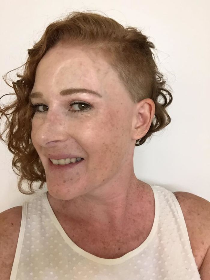 If This Mom's Before & After Photos Don't Scare You About Skin Cancer, Nothing Will