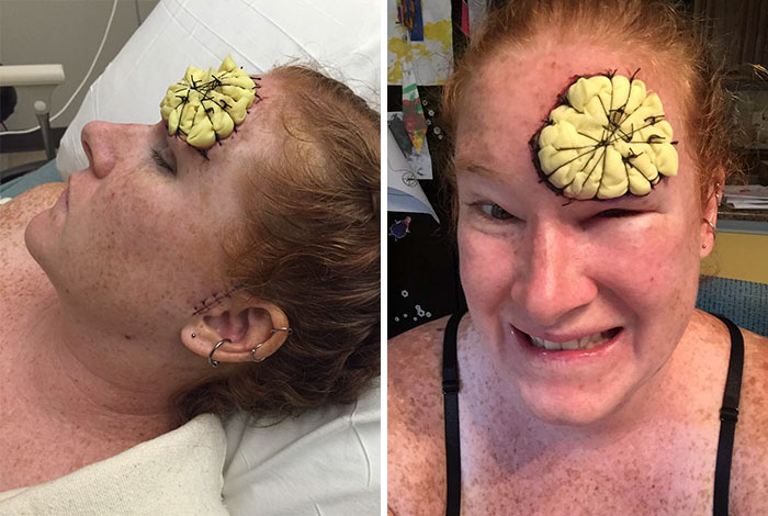 If This Mom’s Before & After Photos Don’t Scare You About Skin Cancer, Nothing Will